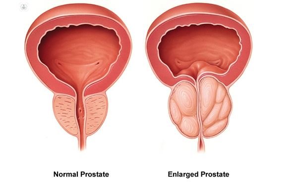 اعراض التهاب البروستاتا