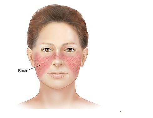 الذئبة الحمراء