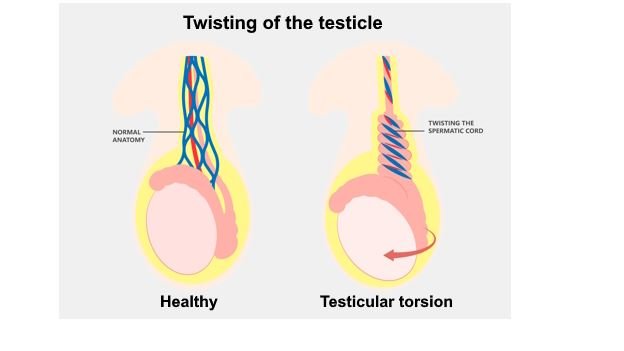 دوالي الخصية